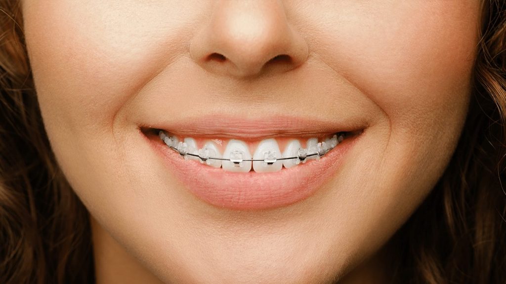 Invisible Braces